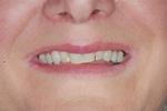 Porcelain-Veneers-Bonding-and-Crowns-Before-Image