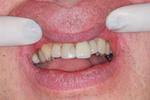 Smile-Makeover-with-Porcelain-Veneers-Before-Image
