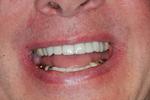 Smile-Makeover-with-Porcelain-Veneers-After-Image