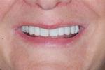Porcelain-Veneers-Bonding-and-Crowns-After-Image